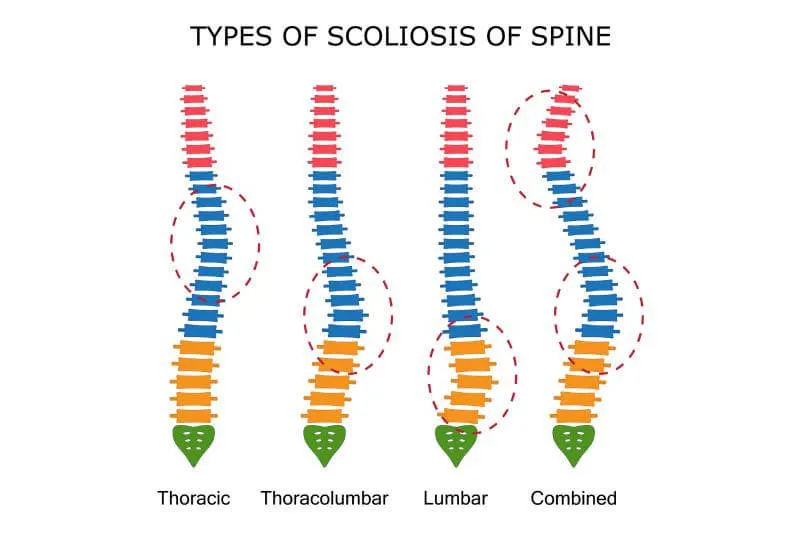 81568808-illustration-of-types-of-scoliosis Scoliosis Chiropractor Near Me in Terrace